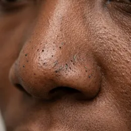 Clogged pores and blackheads on nose and cheeks