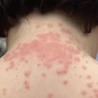 Roanoke family sues Delta and KLM for $200,000 over alleged bed bug injuries.