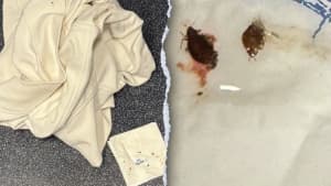Transatlantic Flight Bed Bugs: Virginia Family Sues Delta, KLM for $200K