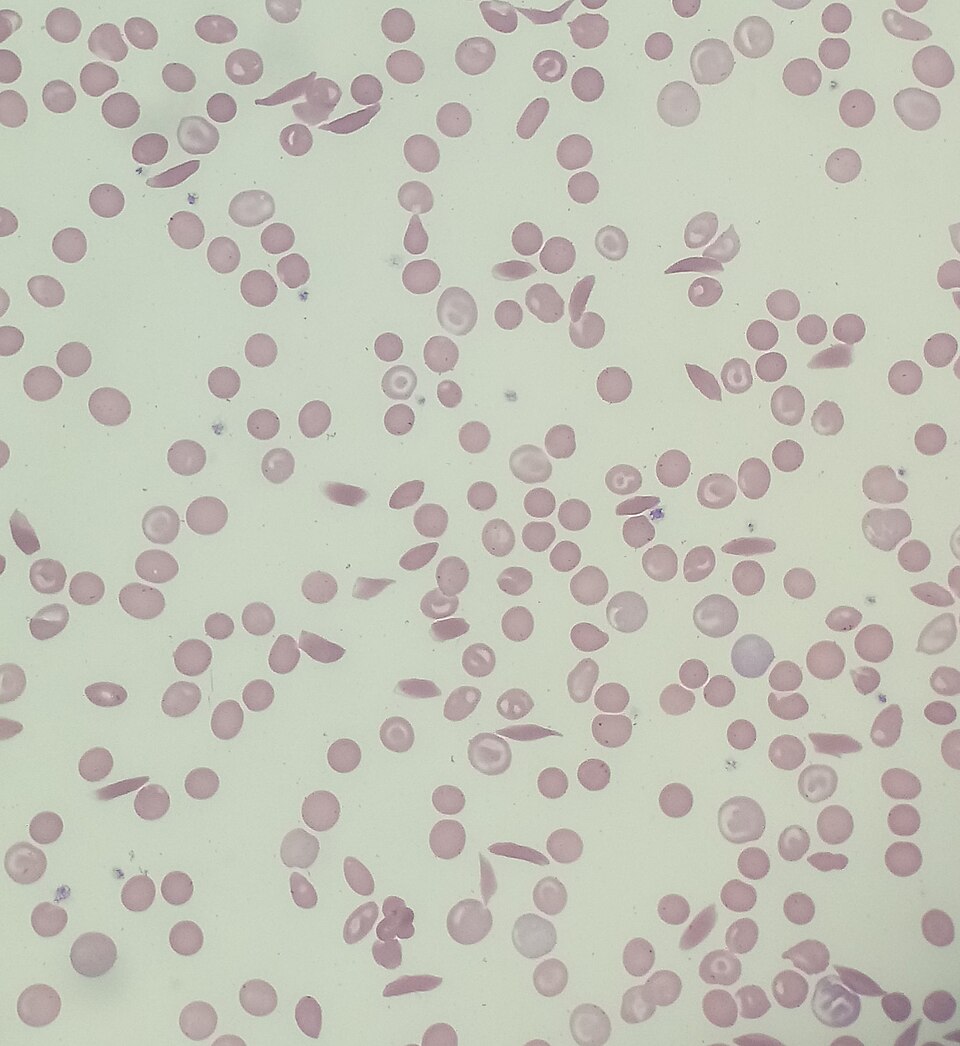 A stained blood smear under the microscope showing many elongated sickle-shaped red blood cells among rounded normal ones