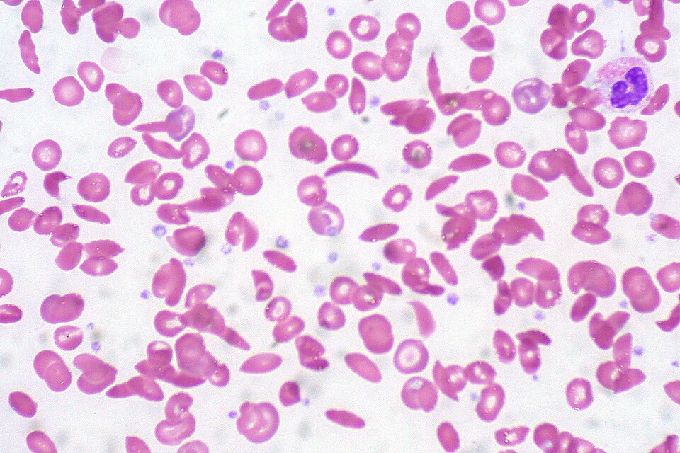 Light micrograph of a stained blood smear in which many red blood cells are crescent or sickle shaped instead of round