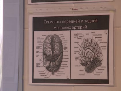 В Астрахани врачи провели женщине редкую операцию на сосудах сонной артерии