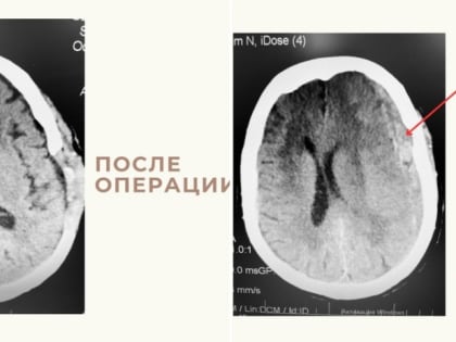 В Астрахани выздоровела 86-летняя женщина с тяжёлым геморрагическим инсультом