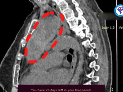 Астраханские врачи провели сложнейшую операцию пенсионерке с огромной опухолью