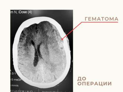 Астраханские врачи спасли 86-летнюю женщину, перенесшую тяжелый инсульт