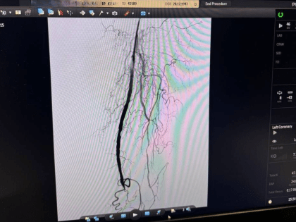 Новый метод баллонной ангиопластики внедрен в Астрахани