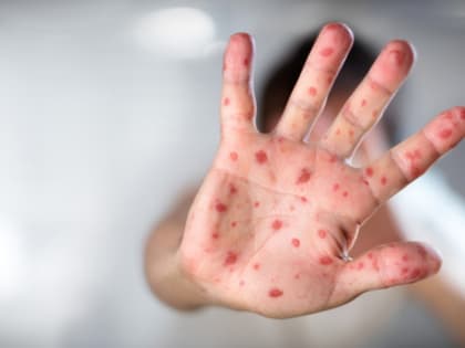 В России резко выросло количество заболевших болезнью, опасной для детей