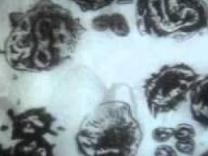 Стимуляция иммунитета может спровоцировать онкологию – эксперт