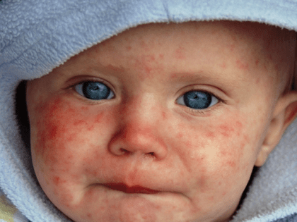 Что надо обязательно знать про корь