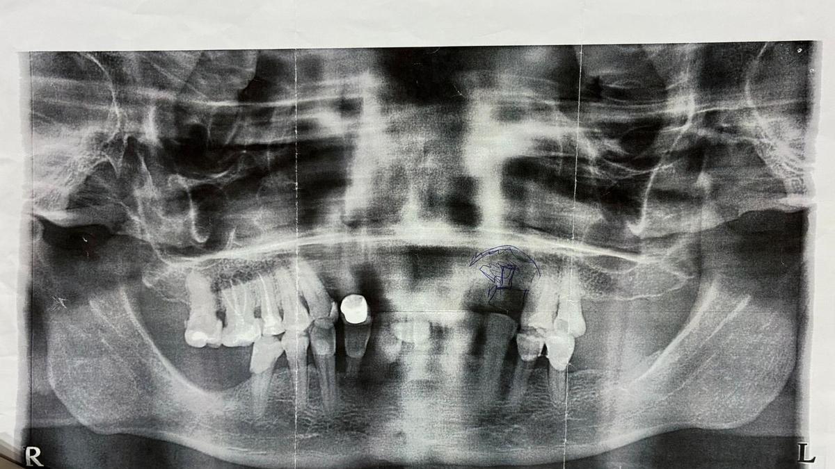 Patient Suffers Dental Damage After Shoulder Surgery in Ibiza, Hospital Delayed Compensation