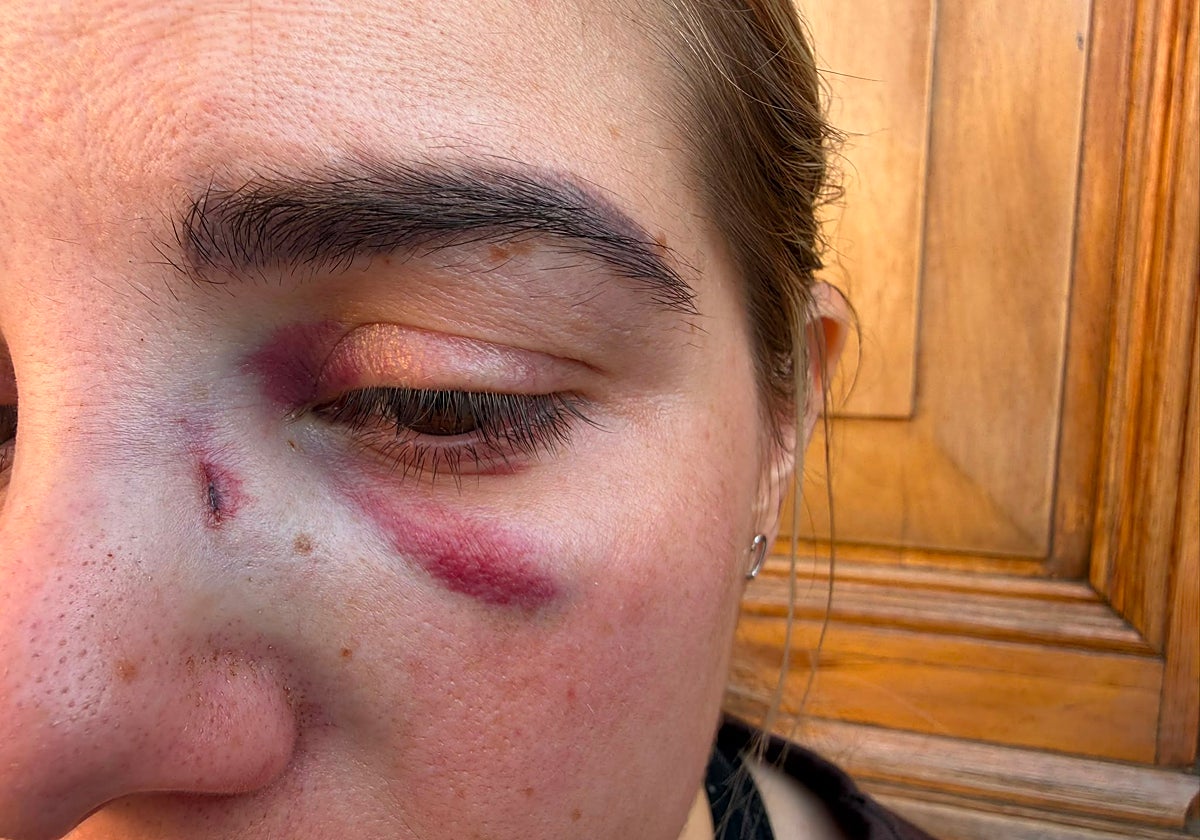 Violencia en consulta médica: doctora sufre fractura nasal tras agresión de paciente