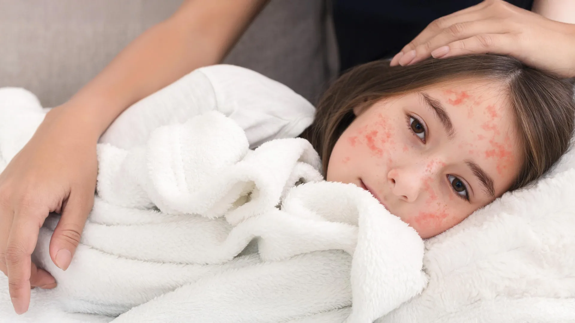 Experimental Antiviral Shows Promise in Preventing Measles Transmission