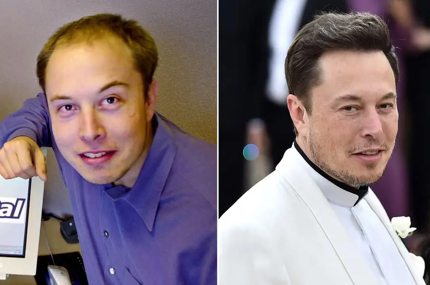 Elon Musk when he was in his twenties, with receding hair, then an image of him older with much more hair.