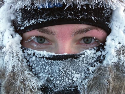 Обморожение