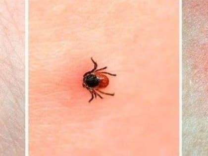 В Якутии зарегистрировано 498 случаев укуса клещами