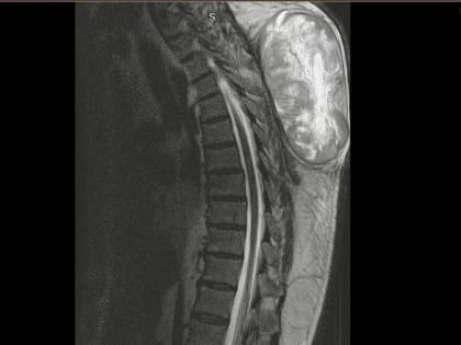 Успешная операция по удалению гигантской опухоли в Туле
