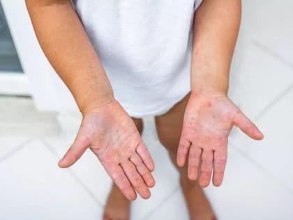 Эпидемиологическая ситуация в Брянской области: вирус Коксаки под контролем