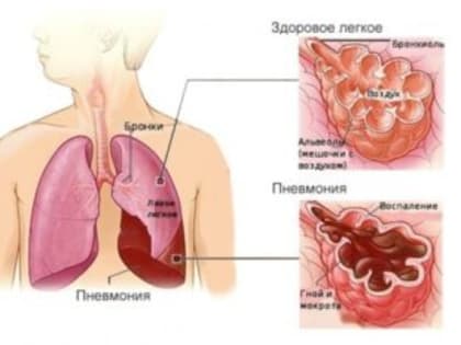 Роспотребнадзор напоминает об основных мерах профилактики пневмонии