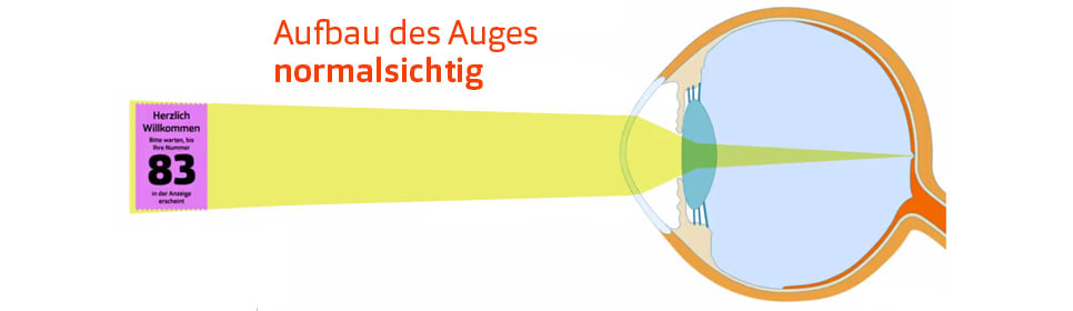 Astigmatismus Hornhautverkrummung Einfach Erklart Pearle