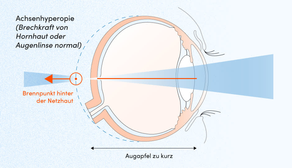 Weitsichtigkeit Anzeichen und Hilfe einfach erklärt
