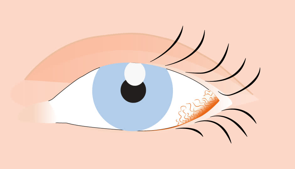 Rote Augen: Ursachen, Symptome und Behandlung - Apollo