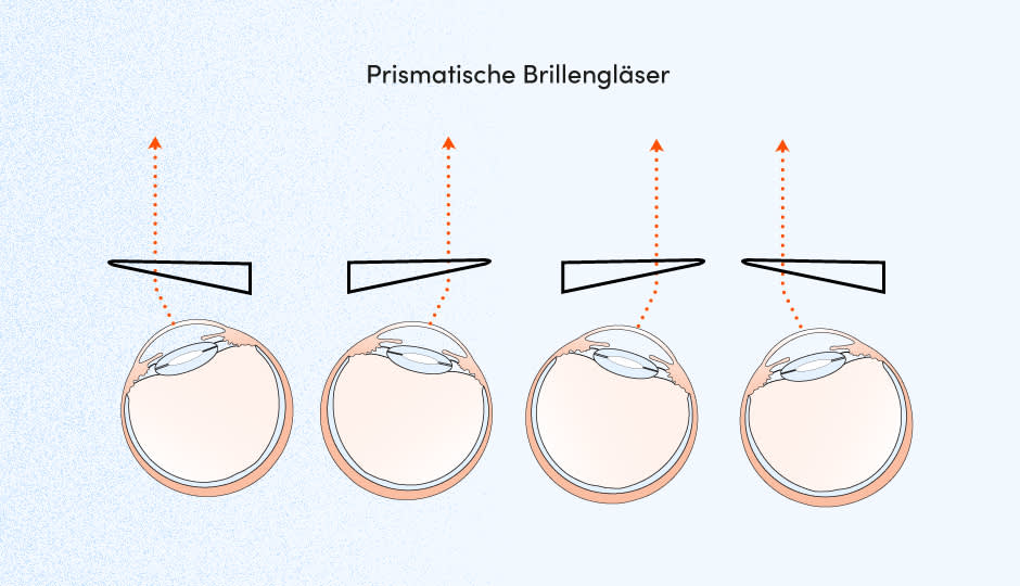 Veranschaulichungsgrafik zu Prismen Brillen