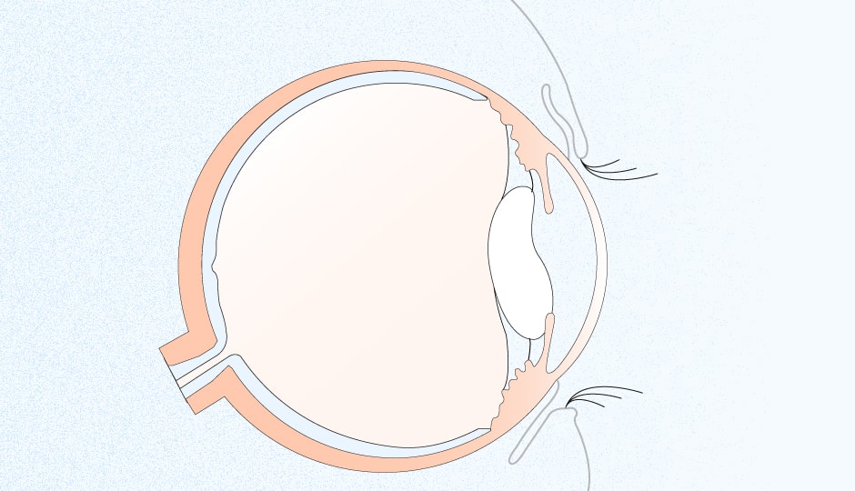 Astigmatismus Hornhautverkrummung Einfach Erklart Apollo