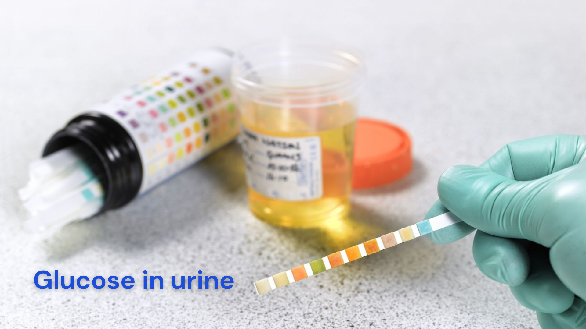 What Does Glucose in Urine Mean?
