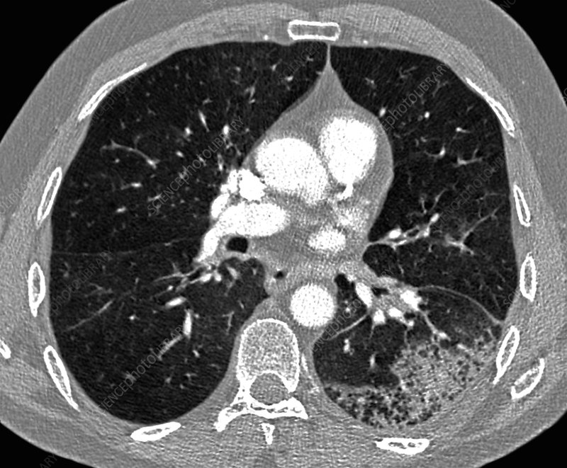 pneumonia-causes-symptoms-treatment-and-prevention
