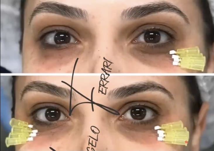 Antes e depois da região dos olhos e sobrancelha