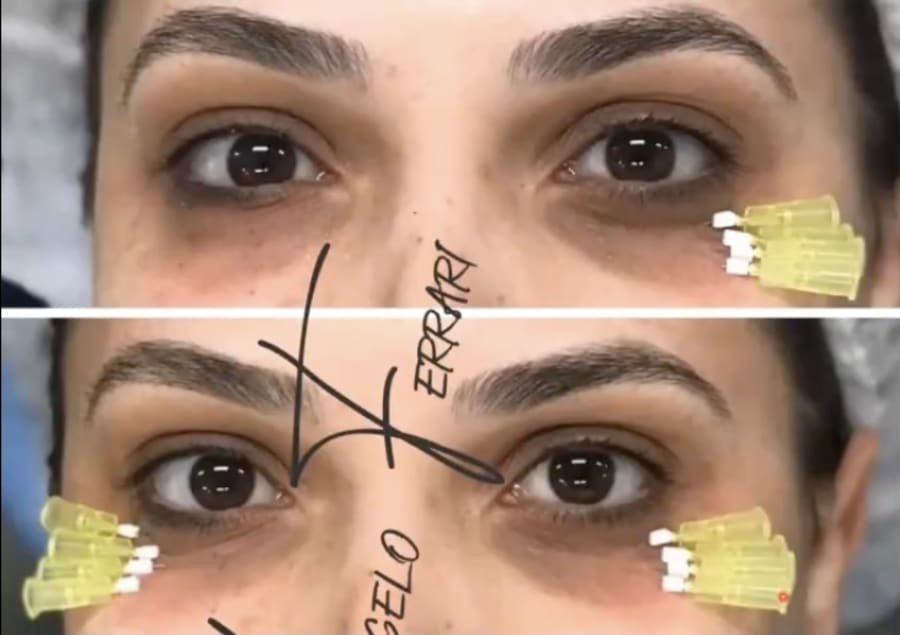 Antes e depois da região dos olhos e sobrancelha