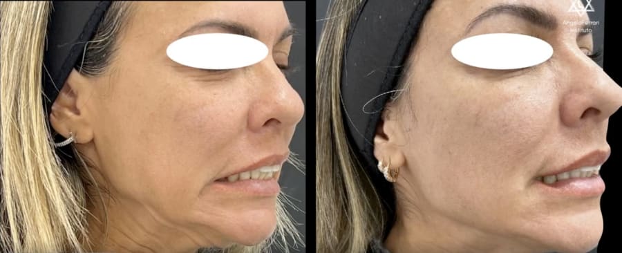 Antes e depois do terço médio e inferior da face