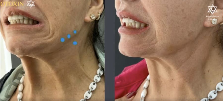 Antes e depois do contorno de mandíbula e pescoço