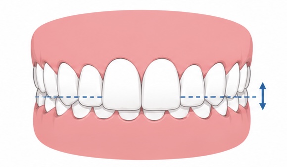 Overbite
