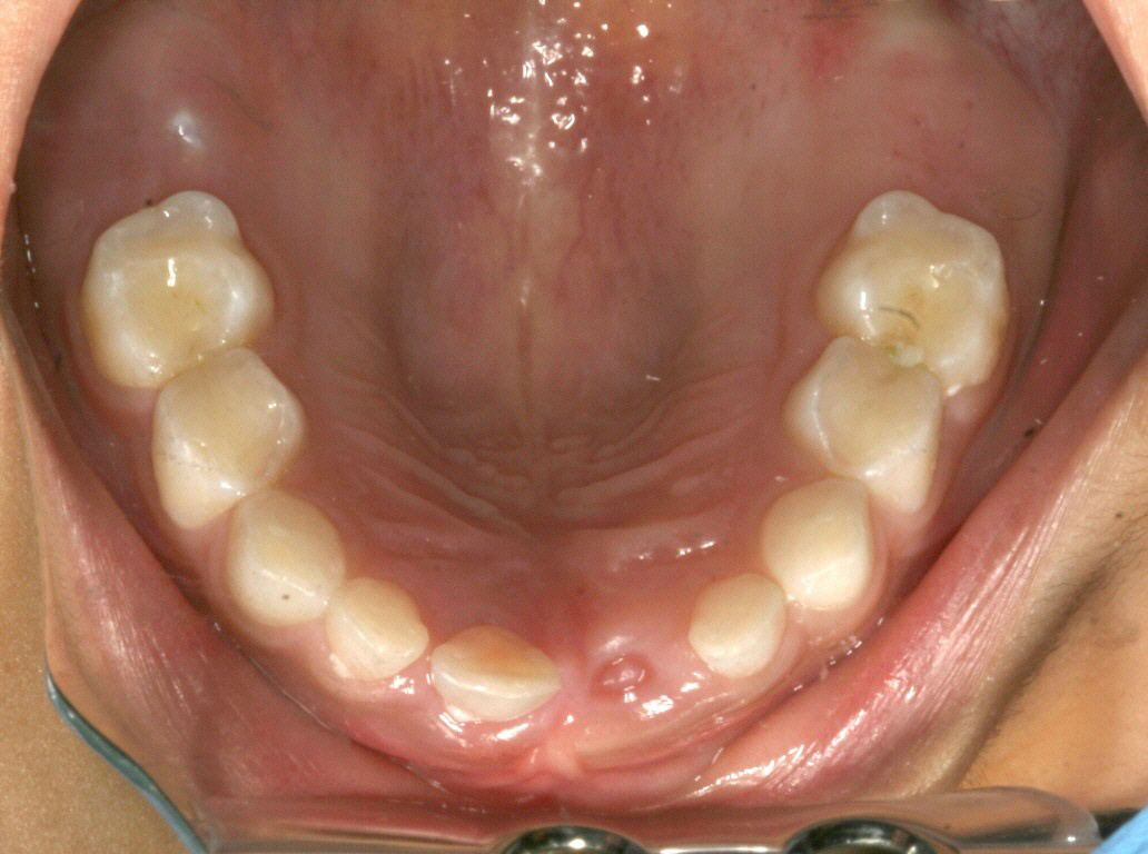 Missing Adult Tooth