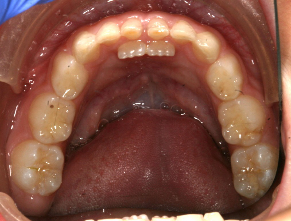 Shark Teeth in Children