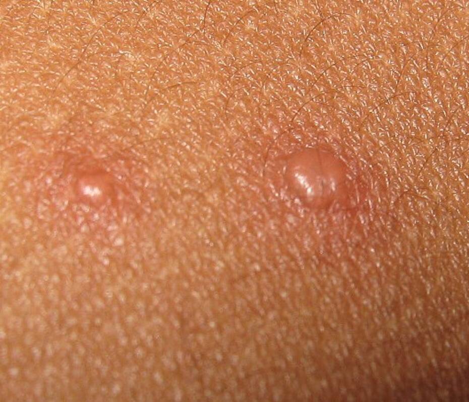 ما هو جدري الماء