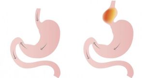 فتق الحجاب الحاجز