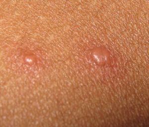 ما هو جدري الماء