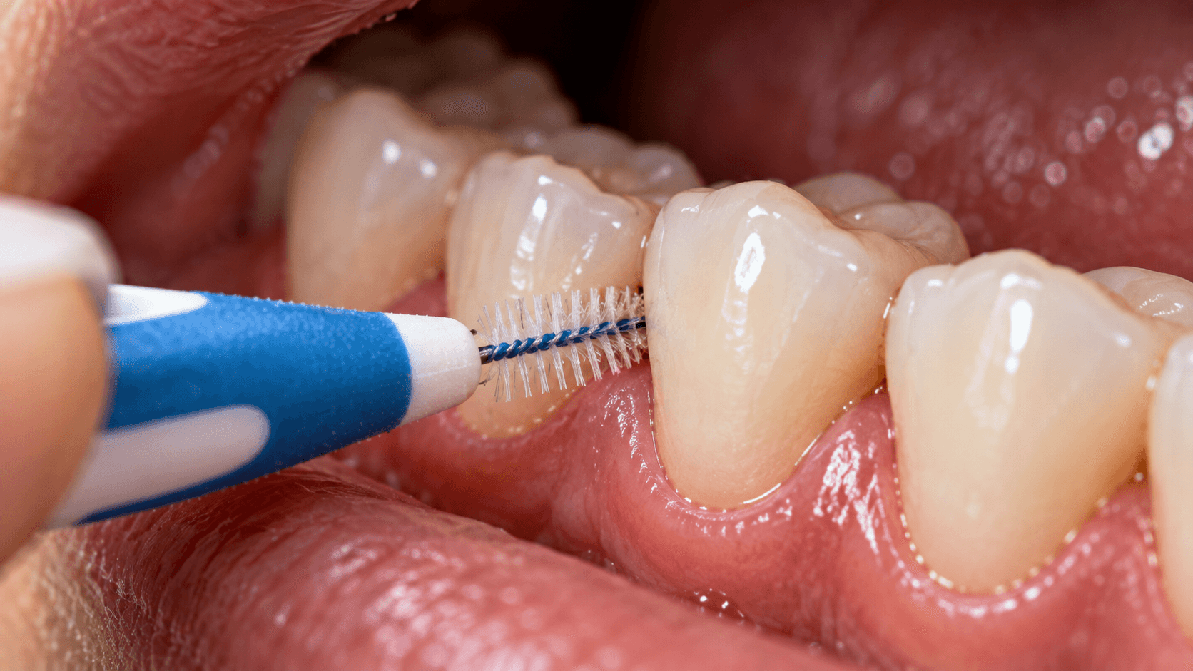 How to Build a Home Care Routine for Periodontal Disease