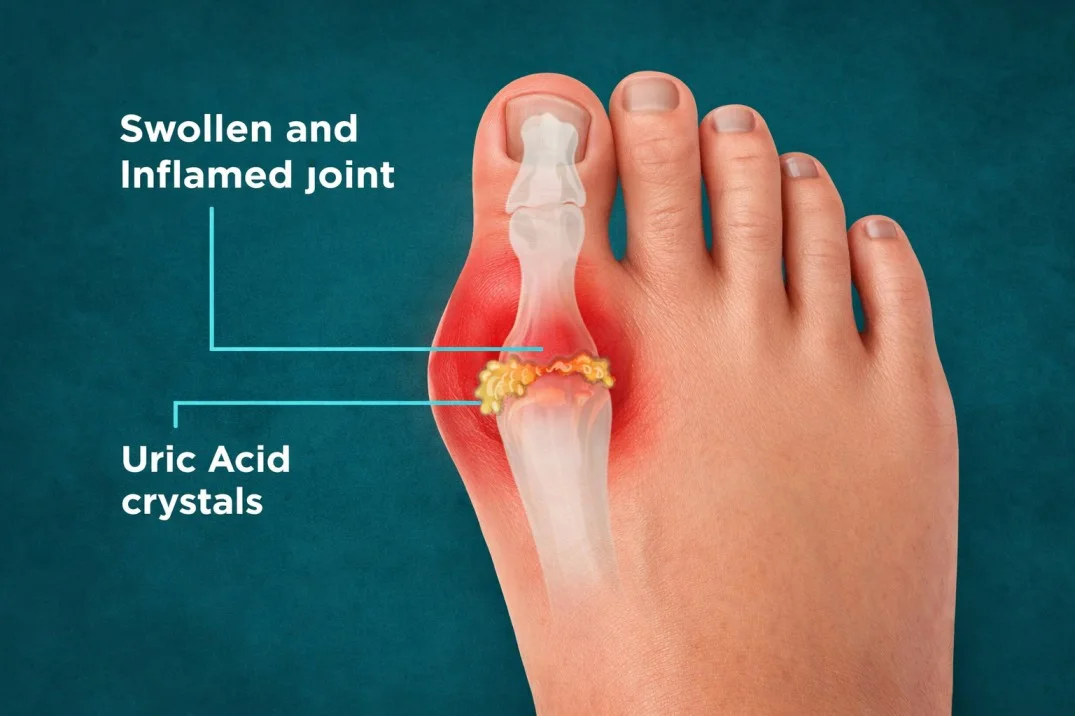 Uric Acid | HealthyRaho.in - Hindi Health Articles