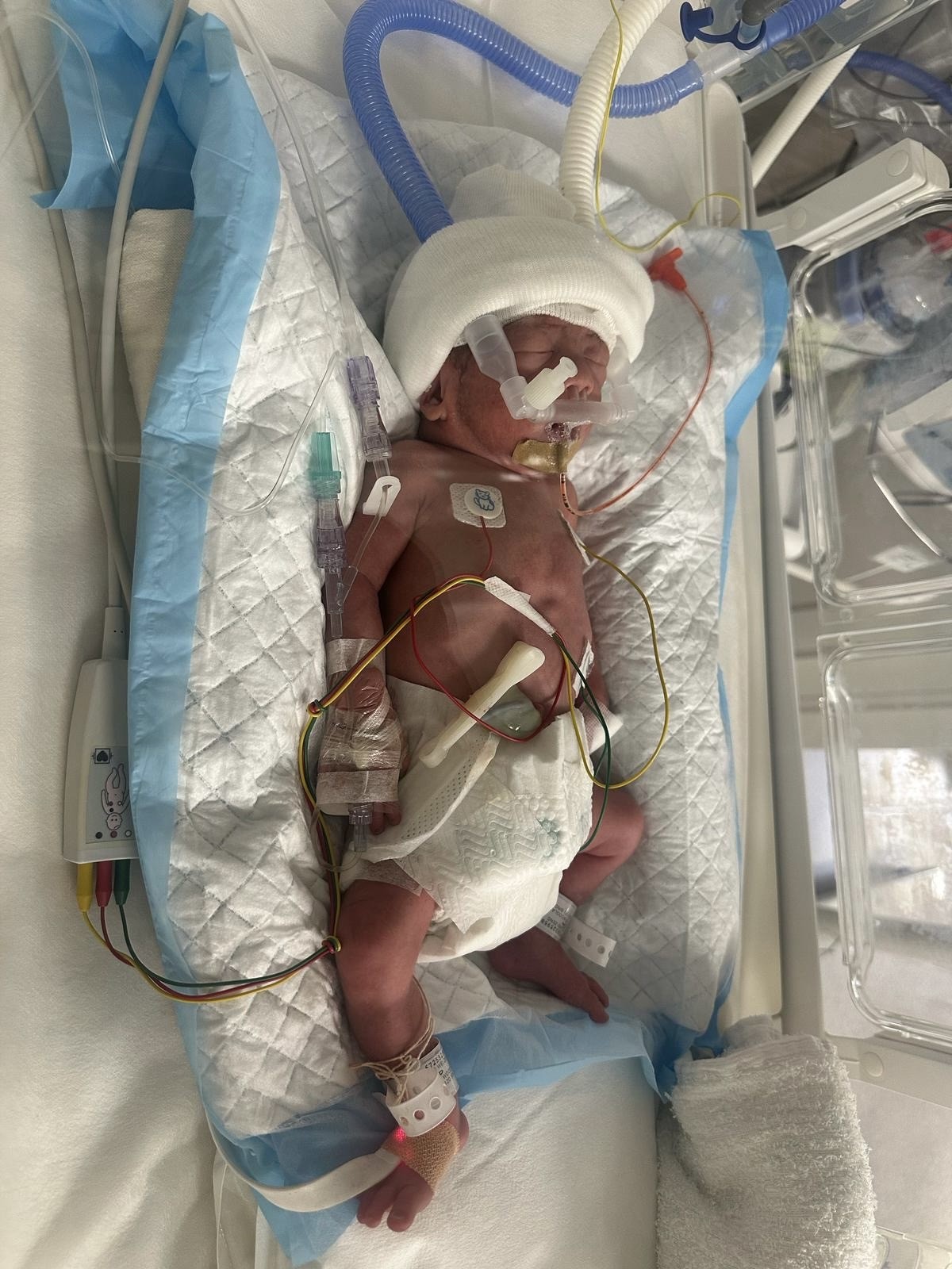 Help Premature Baby Baron Heal After Losing His Twin