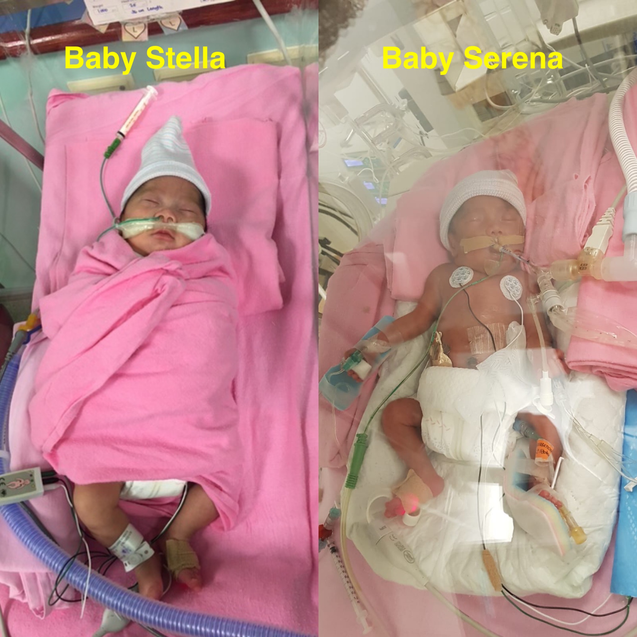 Can you please donate 15 to help Premature Twins Baby Serena