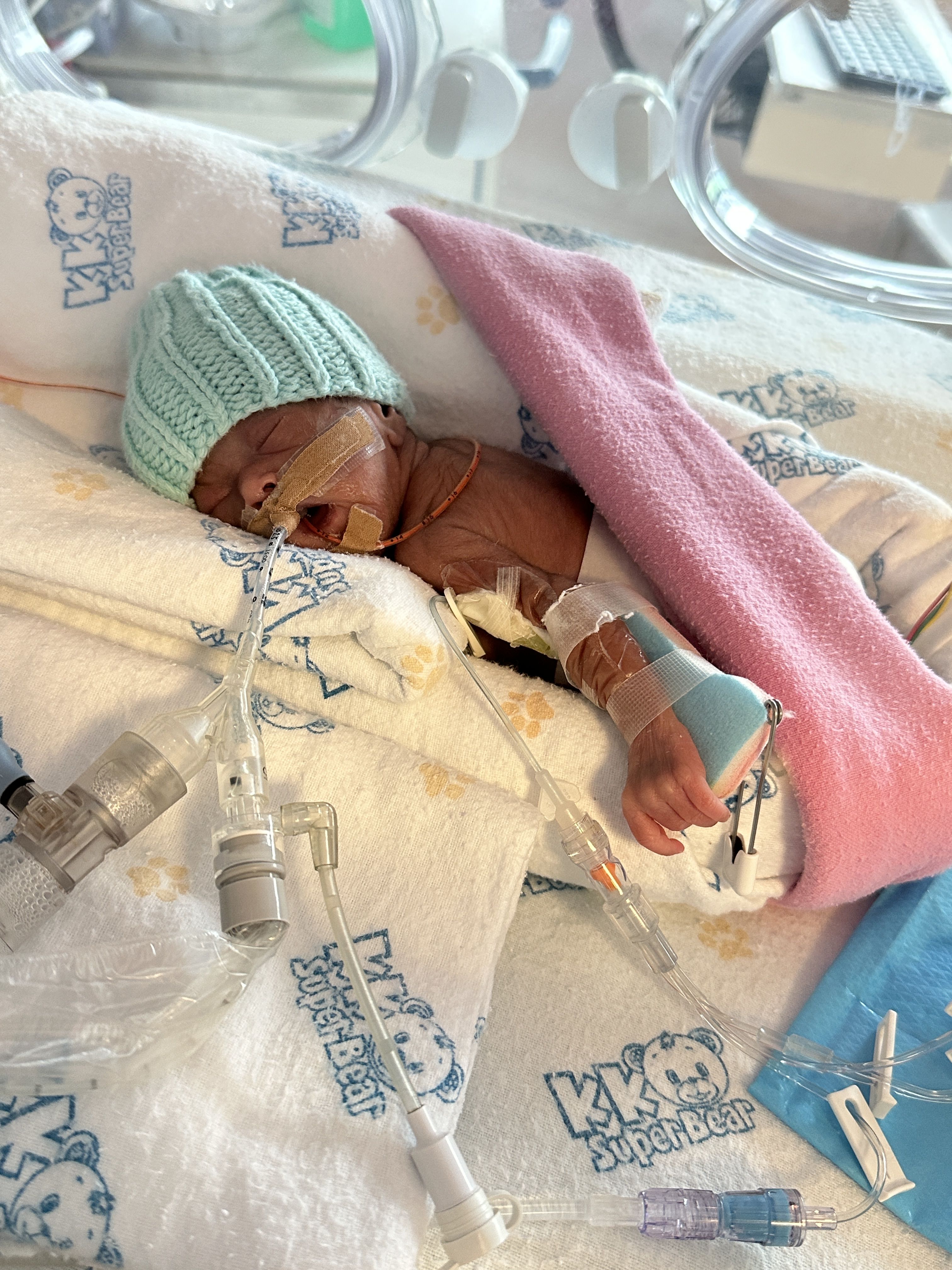 Our Premature Baby Lin Has Fought To Live. Now Our Fight ...