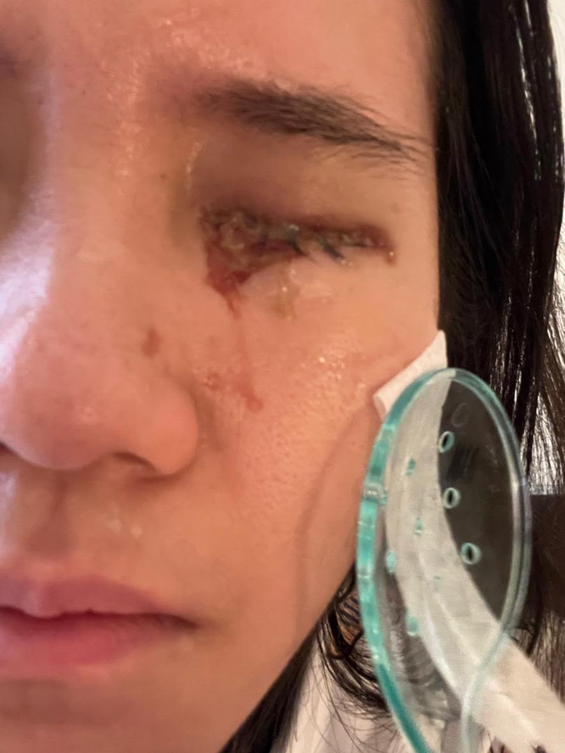 After 11 Surgeries, I Am Still Fighting to See the World Again