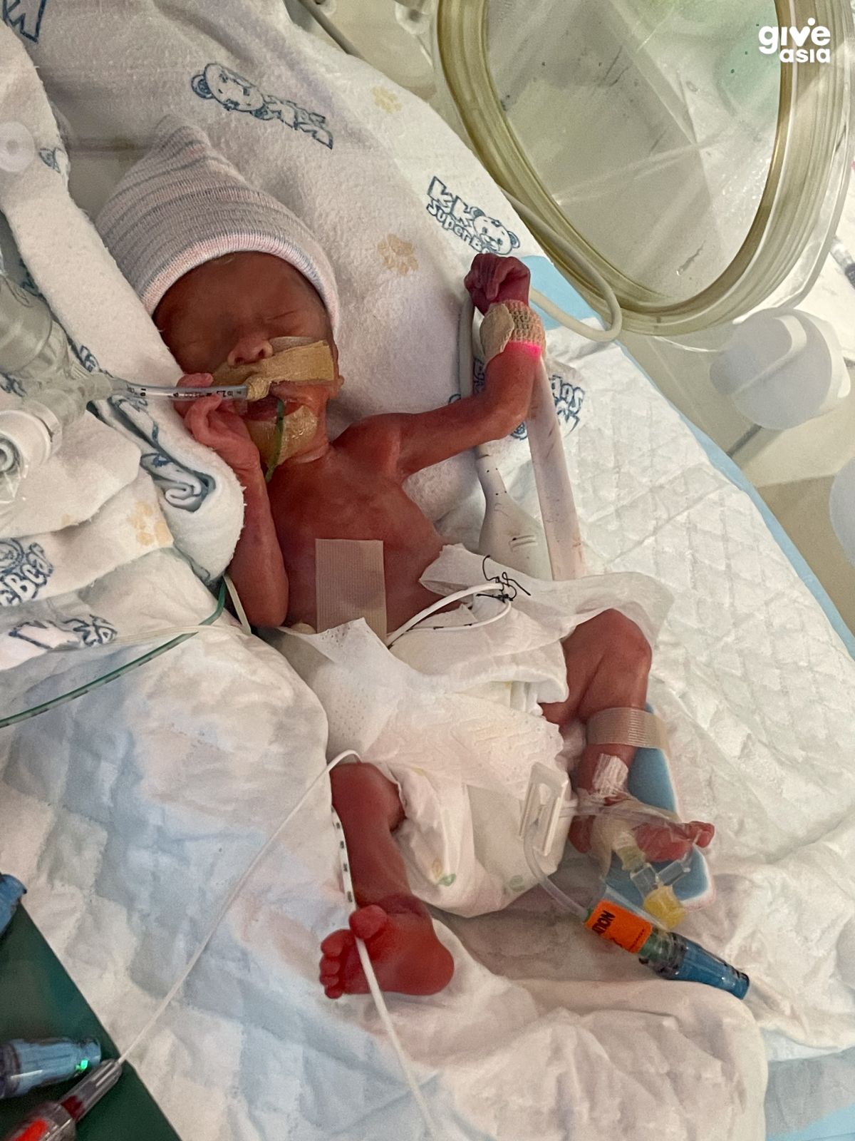 Tiny Fighter, Big Heart The Journey of an Underdeveloped Organs Baby