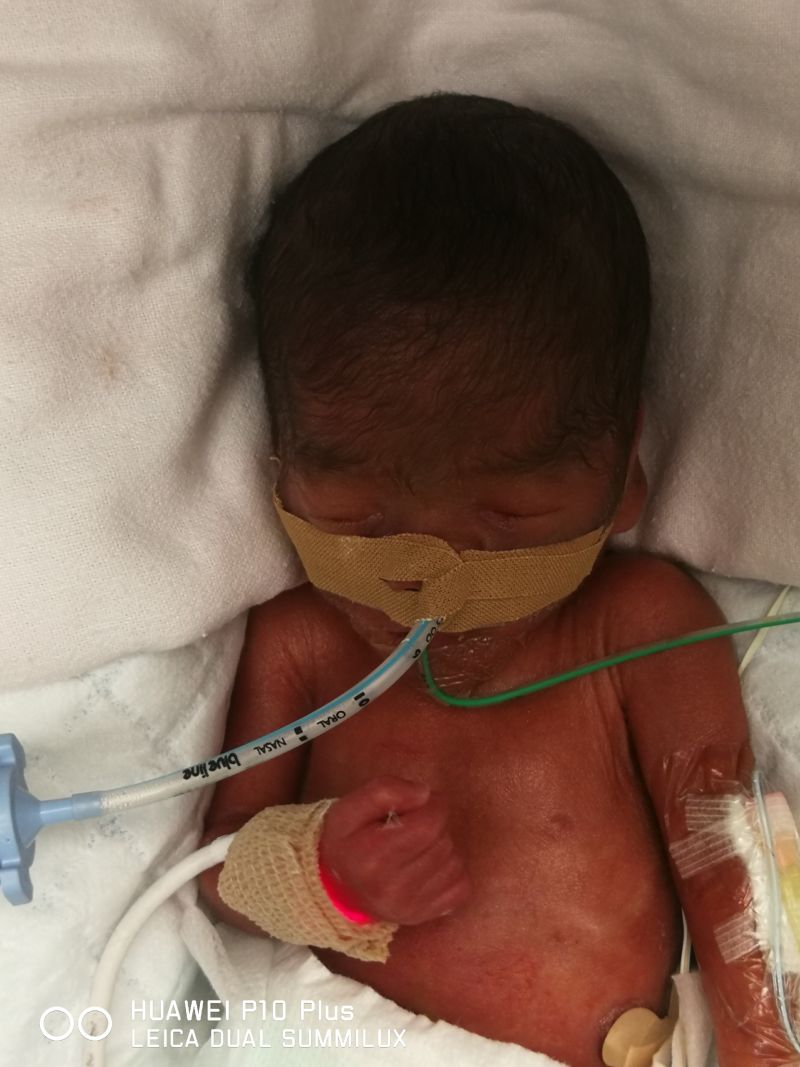 Help My Premature Baby Jasper