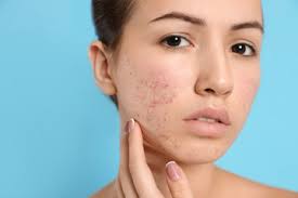 Acne Treatment