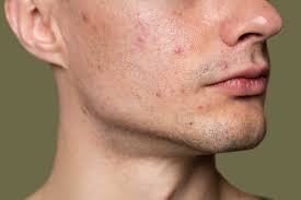 Acne Treatment