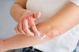 Eczema Treatment